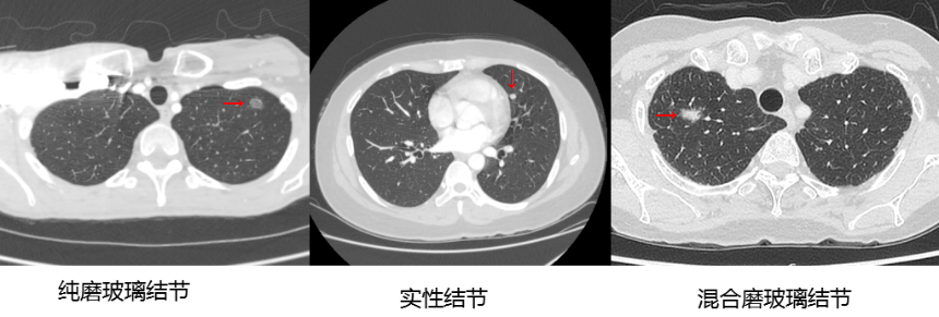 【高新轉(zhuǎn)載】肺結(jié)節(jié)與肺癌有的區(qū)別在哪呢？