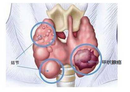 甲狀腺癌為何偏愛年輕人