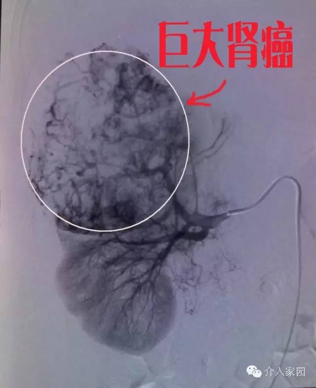 當腫瘤君遇到介入...