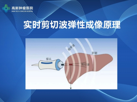 【高新喜報】我院開展肝臟實時剪切波彈性成像檢查技術(shù)，肝纖維化、肝硬化可以無創(chuàng)診斷啦！