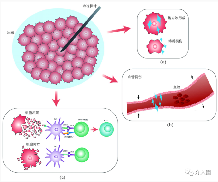 當哪吒敖丙遇上冷熱消融技術(shù)：神奇的醫(yī)學(xué)黑科技
