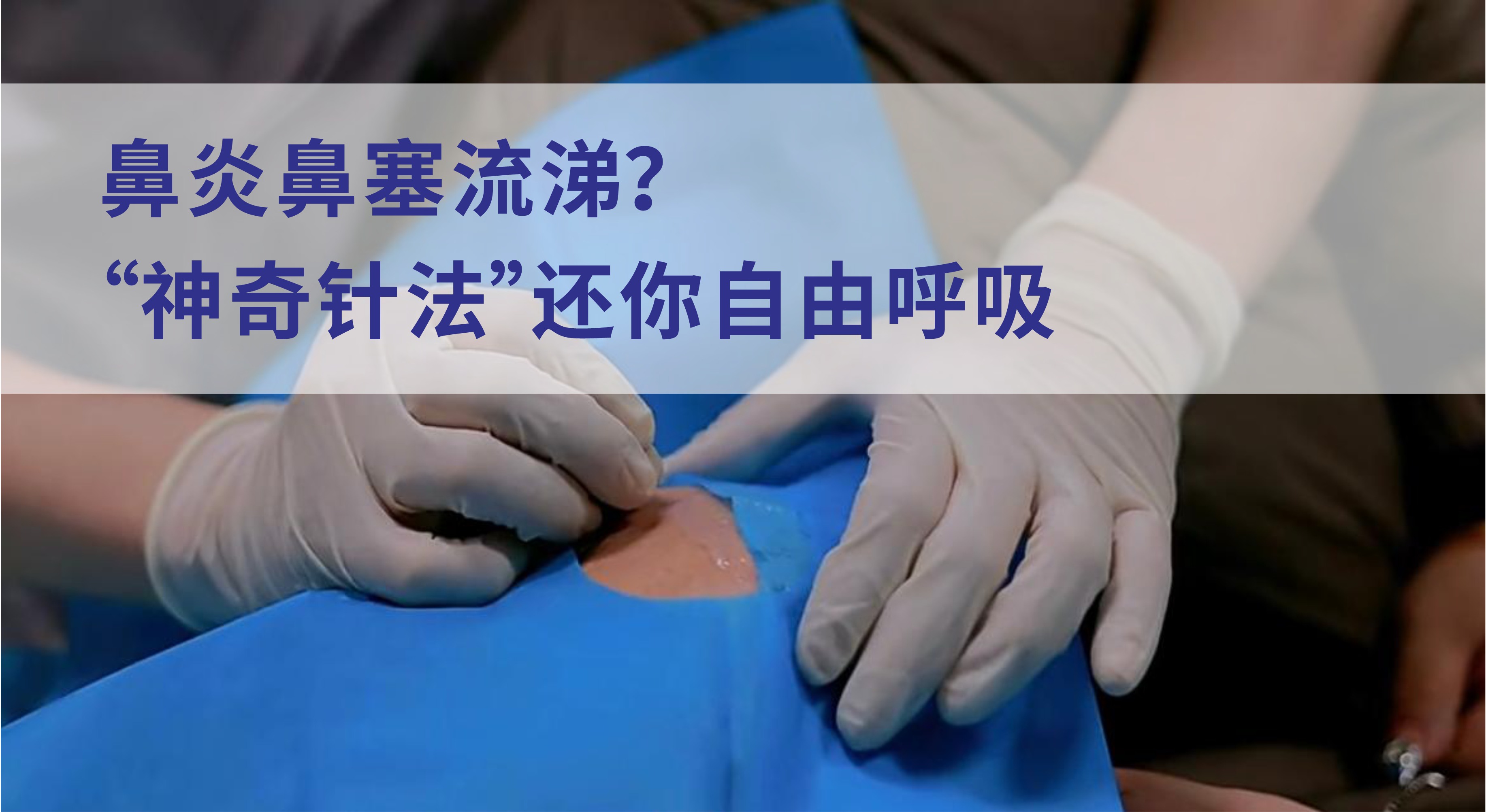 不打針不吃藥！這個(gè)“神奇針法”如何拯救你的鼻炎