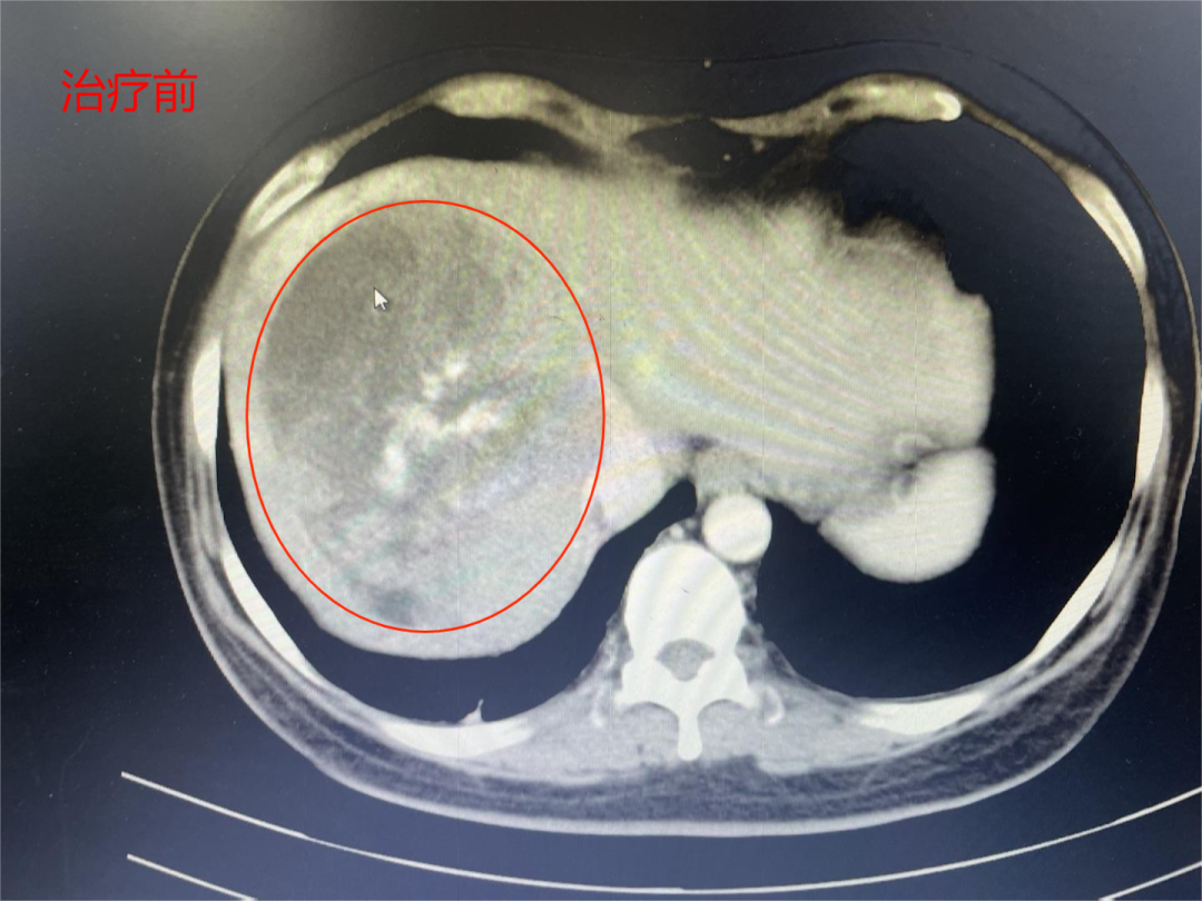【肝癌巨型腫瘤】甲胎蛋白值高達(dá)11萬(wàn)，介入7個(gè)療程，甲胎蛋白降至32