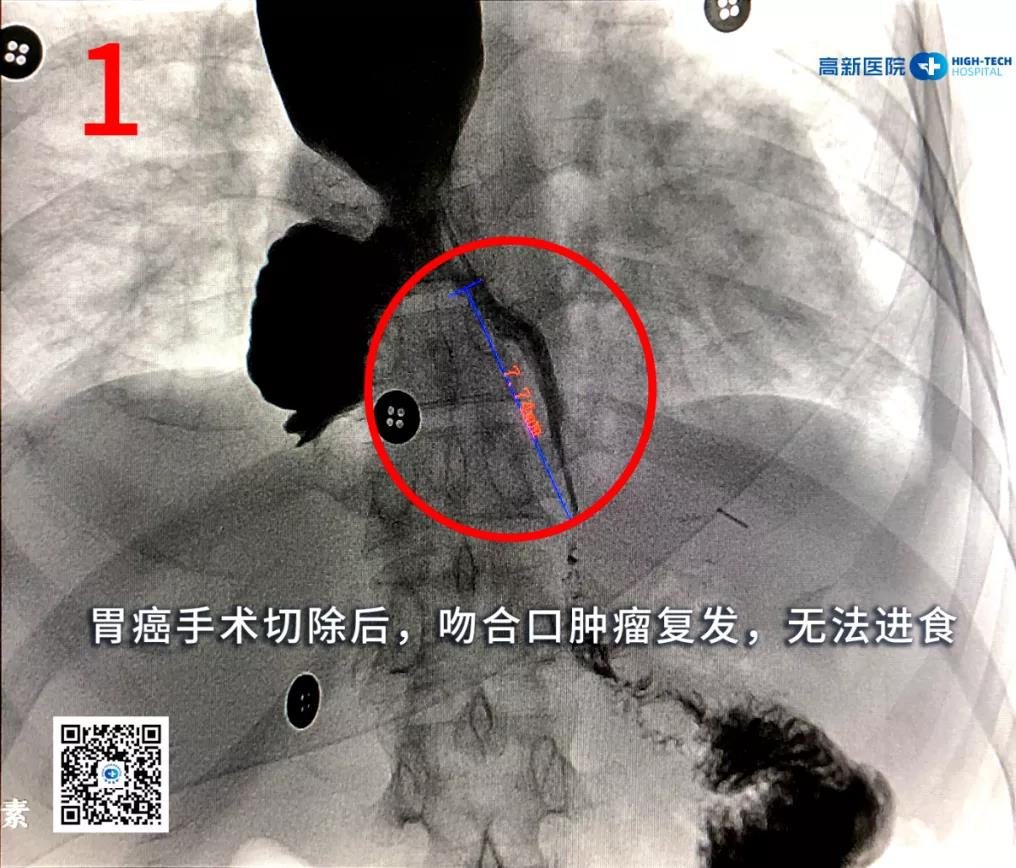 【胃癌】一位胃癌晚期患者從命懸一線(xiàn)到正常生活，幸運(yùn)絕非偶然！