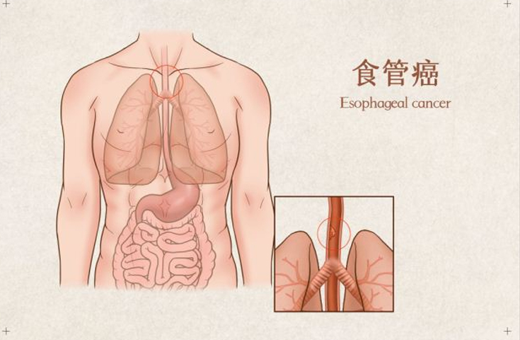 【食管癌】介入化療栓塞術(shù)解決患者吞咽困難